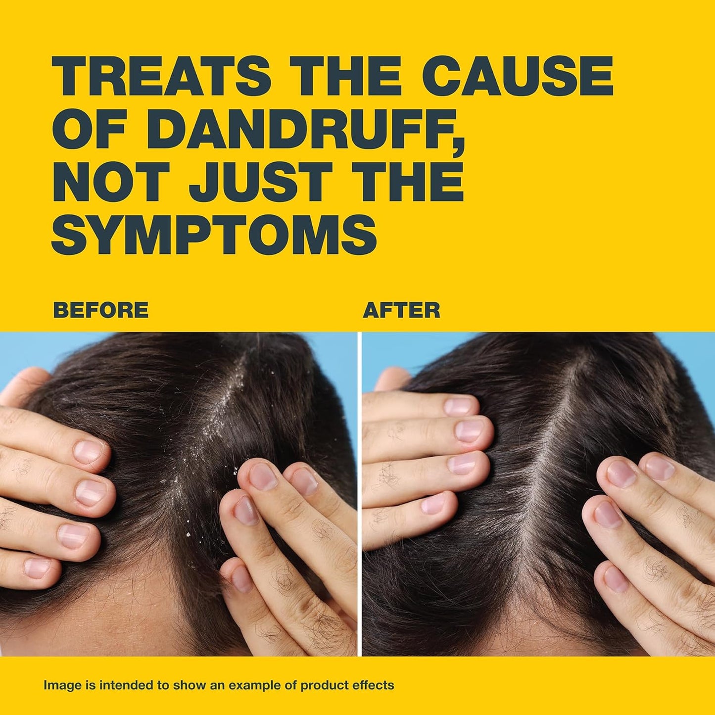 Nizoral® 2% Anti-Dandruff Shampoo, 100ml, Medical Treatment with Ketoconazole, Clinically Proven to Treat Dandruff, Flakes & Itching