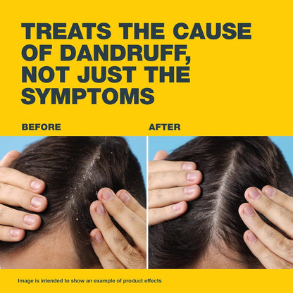 Nizoral® 2% Anti-Dandruff Shampoo, 100ml, Medical Treatment with Ketoconazole, Clinically Proven to Treat Dandruff, Flakes & Itching